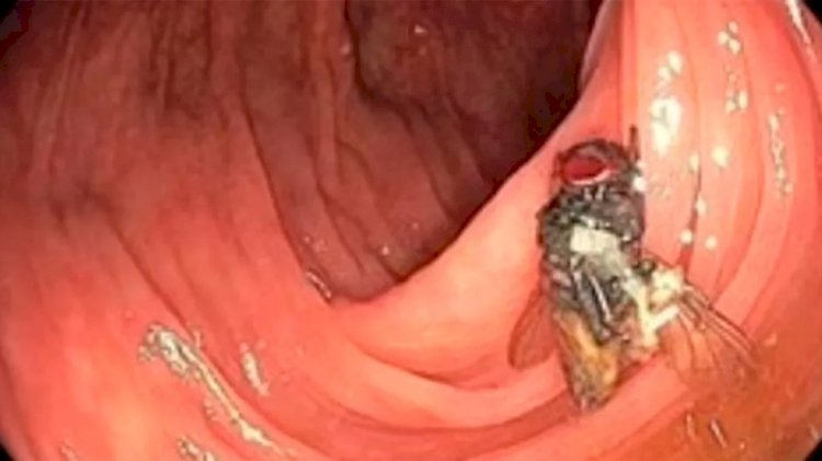 Mosca é encontrada viva em intestino de paciente; entenda o caso